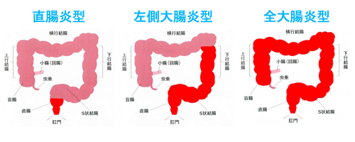 潰瘍性大腸炎